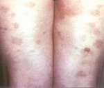 Аллергические васкулиты кожи 