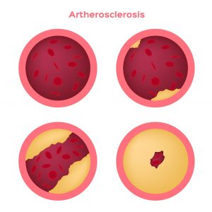 Атеросклероз сосудов головного мозга: симптомы, лечение и профилактика 