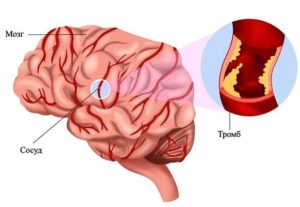 Симптомы тромбоза головного мозга 
