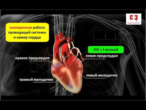 Виды, причины, симптомы и лечение фибрилляции сердца 