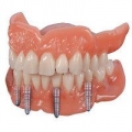 Альтернатива имплантации зубов: существующие аналоги и методы 