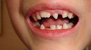 Аномалии формы зубов на фоне системной гипоплазии 
