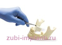 Аугментация — процедypa для восстановления костной ткани челюсти 