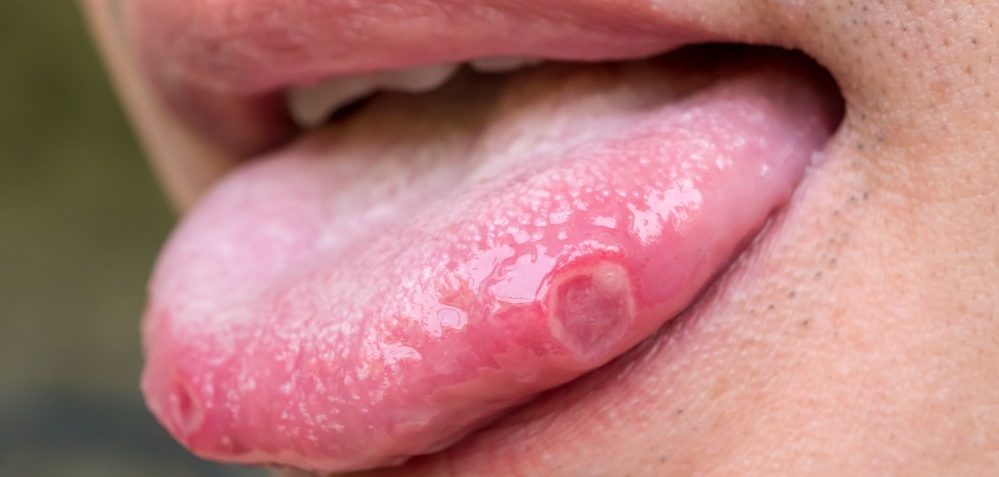 Болит кончик языка — симптомы, причины, лечение 