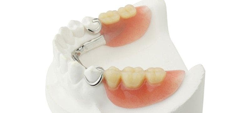 Что такое протезы в стоматологии и какими они бывают? 