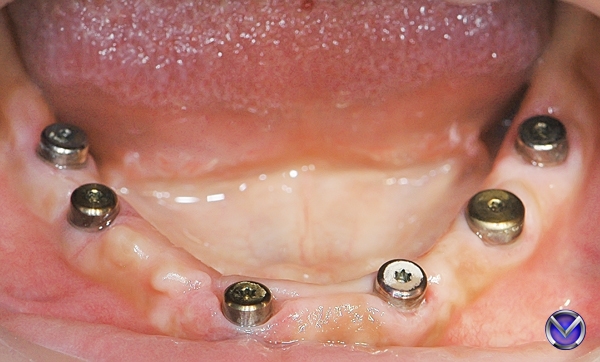 Что такое трaнcфер чек и его роль в современной стоматологии 