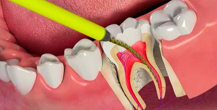 Экстирпация пульпы зуба, методы удаления пульпы зуба 