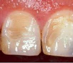Эрозия эмали зубов – от простого дефекта к серьезным заболеваниям 