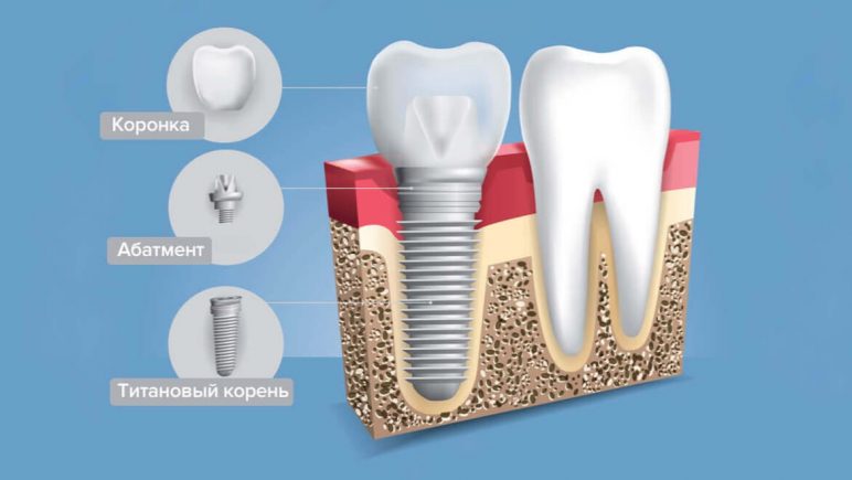 Как долго приживается имплант зуба? 