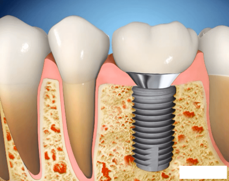Какие методы протезирования без обточки соседних зубов существуют? 