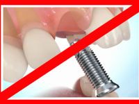 Какие существуют противопоказания для установки зубных имплантов 