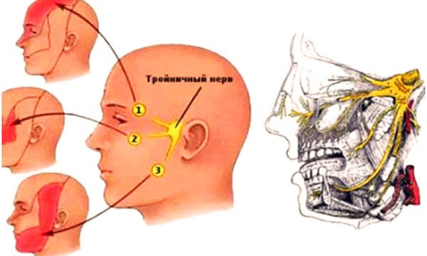 Какими способами лечат воспаление тройничного нерва? 
