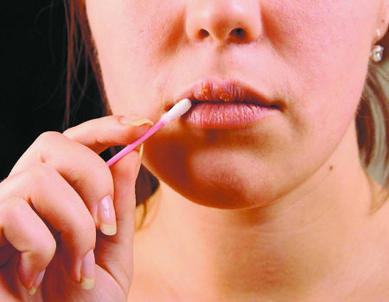 Как лечить гepпeс на губе при беременности: 2 триместр 