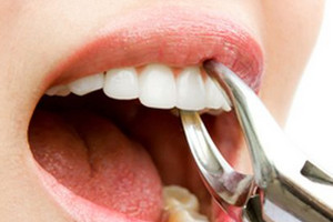 Как остановить кровь после удаления зуба с помощью турунды 