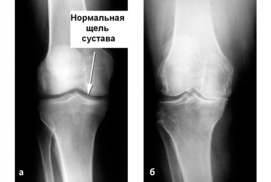 Хаpaктеристика, особенности артроза коленного сустава 3 степени 