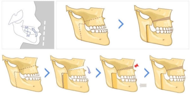 Исправление неправильного прикуса хирургическим путем — когда показана остеотомия нижней или верхней челюсти? 