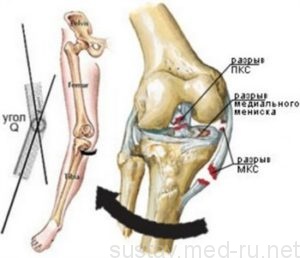 Как диагностировать и вылечить разрыв боковой связки коленного сустава: рекомендации травматолога по предотвращению пожизненной хромоты 