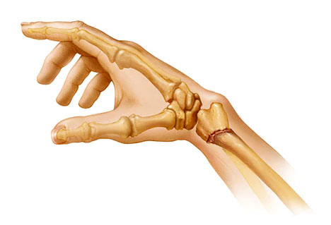 Как долго нужно разрабатывать руку после перелома и какие меры реабилитации предпринять? 