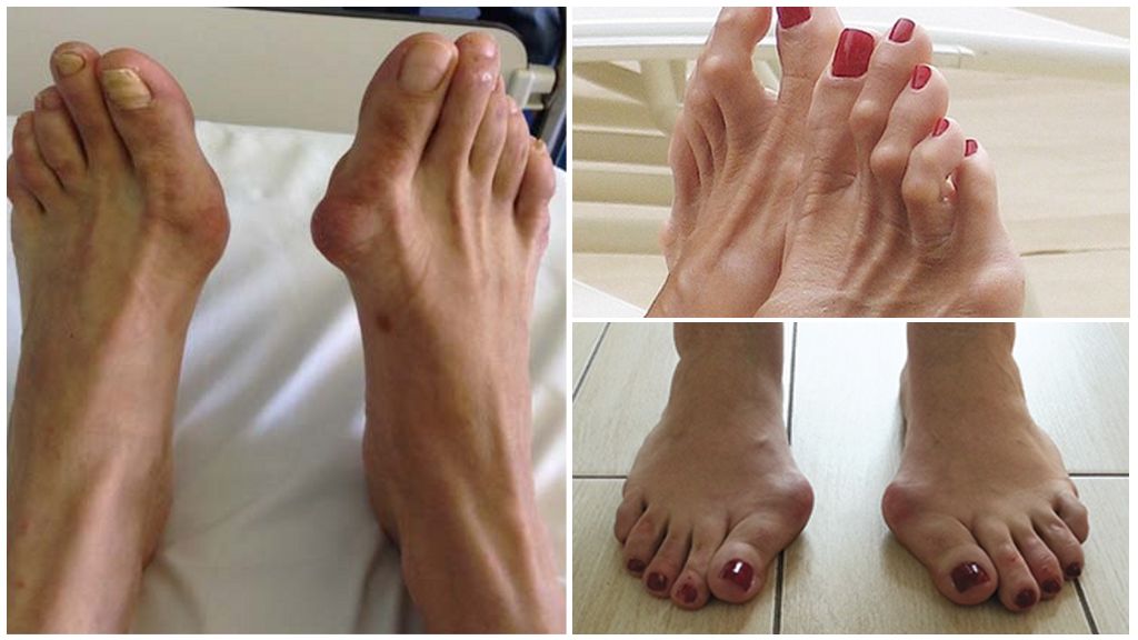 Какие бывают деформации пальцев на ногах и как их исправить? 