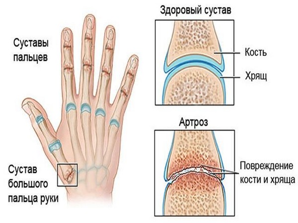 Как лечить артроз пальцев рук с помощью традиционной и народной медицины 