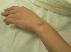 Как лечится воспаление суставов кисти рук 