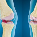 Как поможет ЛФК для восстановления коленных суставов при артрозе 1 и 2 степени? 
