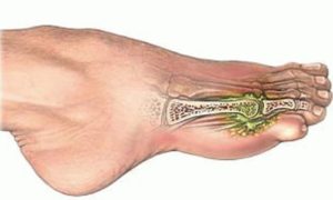 Как зафиксировать перелом большого пальца или мизинца на ноге? 