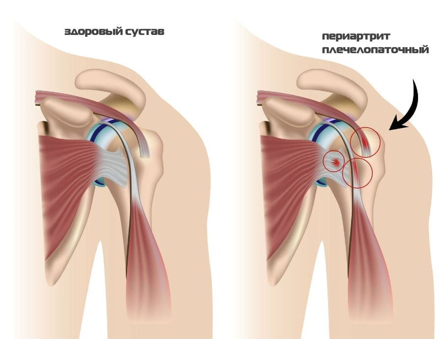 Комплекс упражнений Попова: как вылечить плечелопаточный периартрит? 