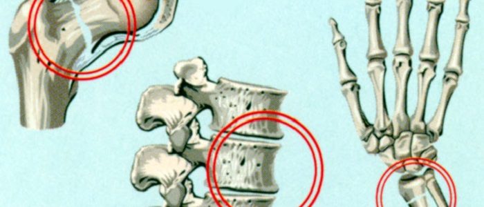 Компрессионный перелом позвонка и остеопороз — профилактика 