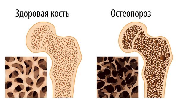 Лечение остеопороза у ребенка 