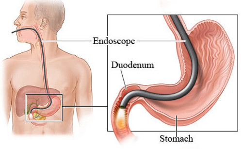 Подготовка к эндоскопическому исследованию желудка 