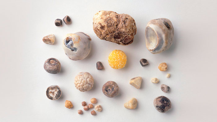 4 разновидности камней появляющихся в протоках желчного пузыря 