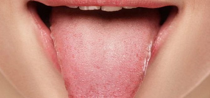 Что делать, если опух язык, какие причины такого состояния? 