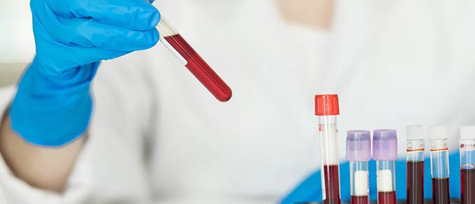Важный анализ крови - гемостазиограмма 
