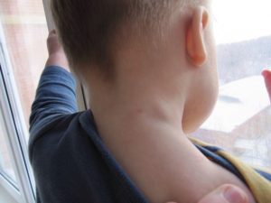 Воспаленные лимфоузлы на шее у детей: по каким причинам они могут быть увеличенными и как действовать при наличии этого симптома 