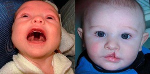 Заячья губа и волчья пасть: фото детей до и после операции 