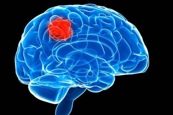 Бластома головного мозга: прогноз жизни, симптомы опухоли, лечение, диагностика 