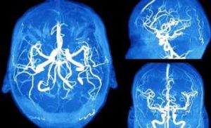 Что такое кистозно-глиозные изменения головного мозга, чем это опасно 