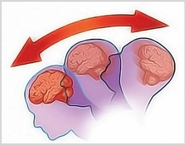Как диагностируется сотрясение мозга? 