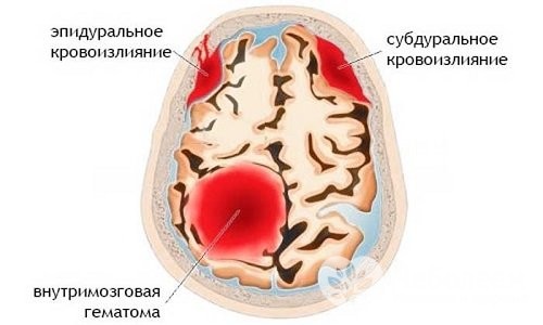 Кровоизлияние в мозг 