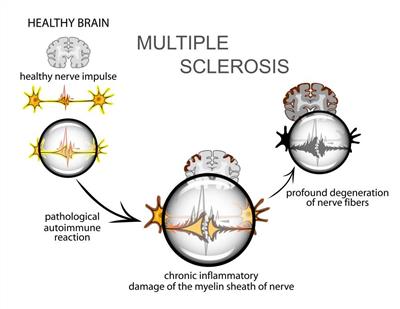 Рассеянный склероз: первые признаки 