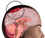 Субдypaльная гематома головного мозга: лечение и последствия 
