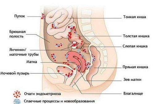 Эндометриоз кишечника и брюшной полости 