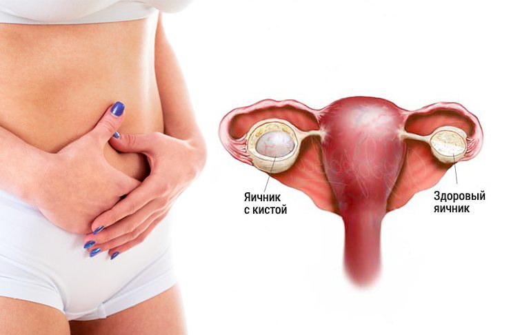Характер выделений при кисте яичника: изменения в менструациях 