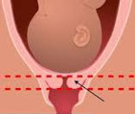 Истмико-цервикальная недостаточность (ИЦН) при беременности 