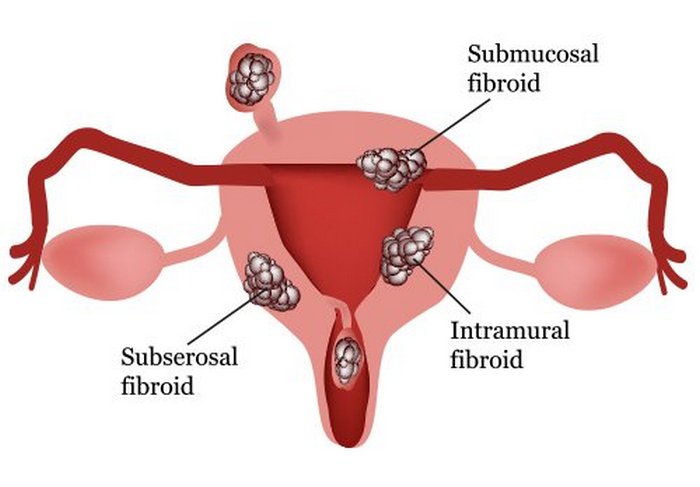 Как вовремя определить и не пропустить фибромиому матки? 