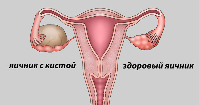 Киста яичника — причины возникновения, признаки, симптомы, лечение и последствия для женщины 