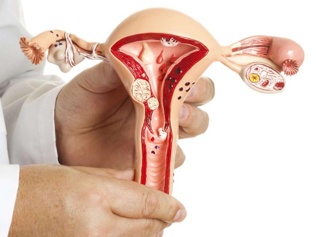 Воспаление яичников у женщин: симптомы и лечение, препараты 
