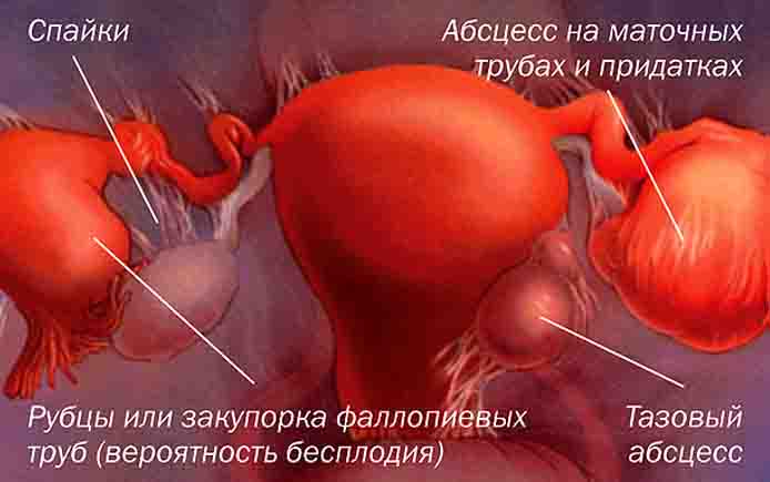Возможна ли беременность при аднексите сальпингоофорите? 