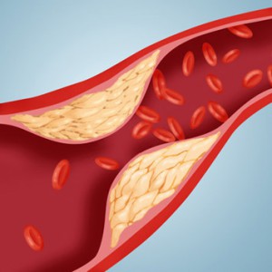 Атеросклеротические бляшшки: в сонных артериях, мозгу, сердце 